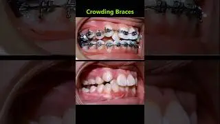 Magic braces. From crowding teerh to perfect teeth #braces #orthodontist #dentist #teeth
