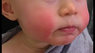 Ep 52: Fifth Disease - Parvovirus B19