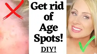 GET RID OF AGE SPOTS!  DIY in 10 days! #agespots #getridofagespots #thatssotrishy