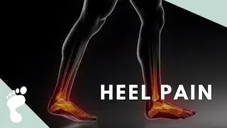 PLANTAR FACIITIS | The Most Common Heel Pain Complaint