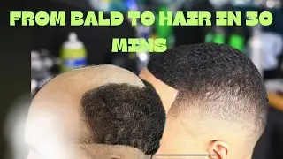 Game-Changer for Balding Men! Full Hair Replacement Transformation