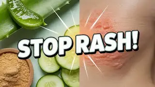 5 Home Remedies for Heat Rash: No Chemicals, Just Relief