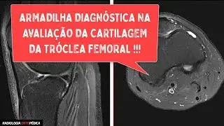 Cuidado com essa armadilha diagn&oacute;stica: Pseudoles&atilde;o condral na tr&oacute;clea femoral !!!