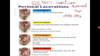 Sultans/classification perineal injury complete  perineal tear /OASIS/made easy /vaginal  delivery/