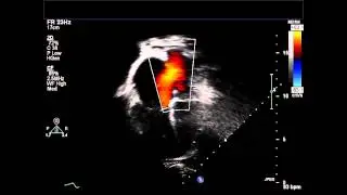 Secundum ASD Apical Four Chamber Color Doppler
