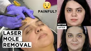 LASER MOLE REMOVAL IN INDIA | Cost, Precautions and Side Effects | Beauty Edit by Amy