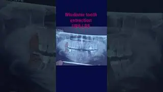 winsdom teeth extraction UR8 , LR8