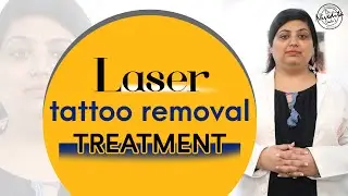 Laser से टैटू हटाने का सही तरीका |  Laser Tattoo Removal | Alma Q | Dadu Medical Centre