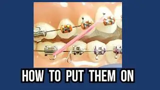 Tutorial: How to put rubber bands on your braces