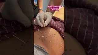 DRY NEEDLING SCIATICA PAIN TREATMENT! #chiropractic #chiropractor #sciatica #backpainrelief #chiro