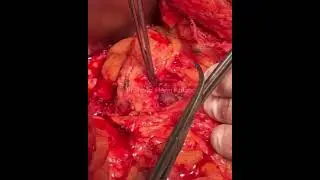 Whipple procedure + Right nephrectomy. Full video