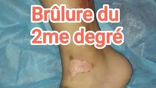 comment faire un pansement pour une br&ucirc;lure du deuxi&egrave;me degr&eacute;