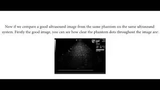 CARDIAC PHASED ARRAY