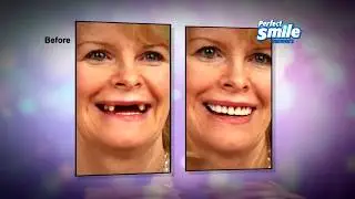 Dents de Remplacement Amovibles et R&eacute;utilisables, 1 achet&eacute;, 1 offert