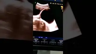 Rare medical case: Seminal vesical cyst
