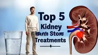 Top 5 Effective Treatments for Kidney Stones | Fast Relief Tips