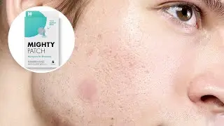 Your Early-Stage Acne Hero: Micropoint for Blemishes | Hero Cosmetics