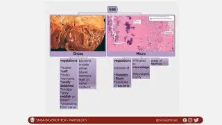 Subacute infective endocarditis : part 2
