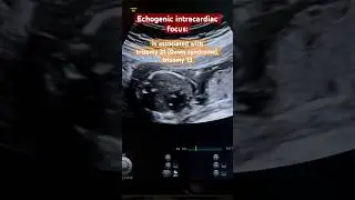 Echogenic intracardial focus facts, EIF anomaly scan ultrasound, fetus sonography, ARDMS
