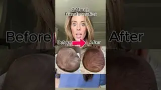 Watch This 2 Month Flat Head Transformation #plagiocephaly