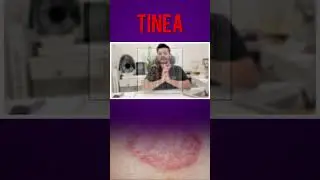 दाद ठीक नहीं हो रहा, वापस हो जाता है कैसे ठीक करें? #दाद #खाज #खुजली #Ringworm #SkinInfection
