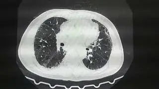 कोई बता सख्त है इस पेशेंट को कौनसी बीमारी है HRCT Chest