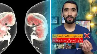 Fetus In Fetu || Vanishing Twin syndrome explained in Pashto