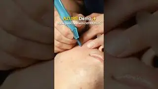 Real-Time Acne Treatment with COTRAPLUS & AZURE