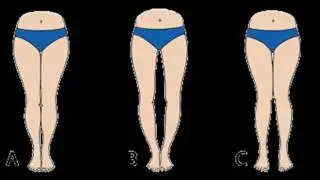 Bow legs no more discounts
