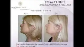 SYGMALIFT FACIAL CONTOURING  ( Launched by SPECTRONIX IN UAE )