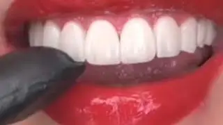 Top Veneers Dental_24 Mei 2024