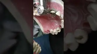 Preparación premolares parte 2