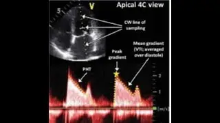 Mitral stenosis Quantification, Gradients, CE, PISA and MV Resistance