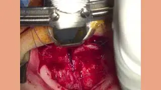 580 Robotic Microscope-Assisted Primary Cleft Palate Surgery First pilot