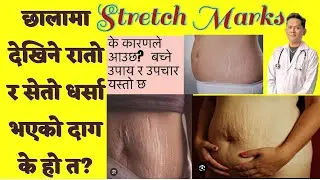 Stretch Marks / Cause/Symptoms/Precaution/Treatment