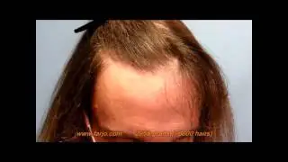Hair Transplant Result | Lucinda Male to Female Transgender Hair Transplant