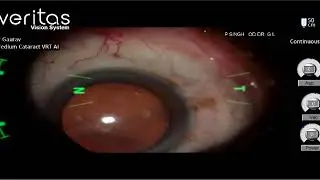 Live Cataract Surgery by Dr Gaurav Luthra