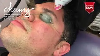 LaseMD, a non-ablative laser.