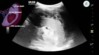 Splenic Injury Grade III on Ultrasound | AAST Trauma Case