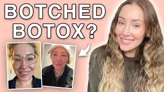 What REALLY Happens When Botox Goes Wrong?