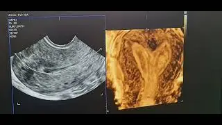 Septate uterus in 3-D image with new Hera i10 sonography machine