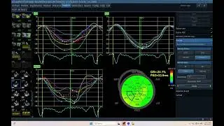 IQ 678 LVEF LV GLS LV PSD ECHOCARDIOGRAPHY ECHOPAC ANALYSIS 2