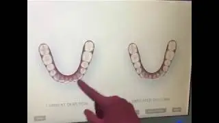 Best Invisalign Dentist in San Diego | Fremont Dentistry| Invisalign Simulation ( Before and After)