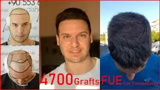 Hair Transplant Evolution / Evaluación de Injerto Capilar