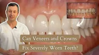 Full Mouth Reconstruction with Veneers and Crowns