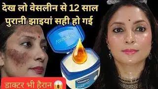 वेसलीन से झाइयां झुरिया हटाने का नायाब नुस्खा Reduce Melasma 