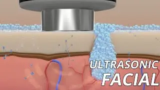 What Is An Ultrasonic Facial? US$25.99 !!!! to Get It Back!