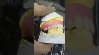Teeth Arrangement Of Upper Complete Denture 😁😁😁#completedenture #dentures #viralvideo