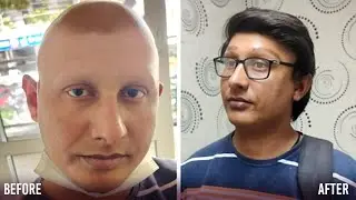 From Zero Eyebrows To Thick Full Eyebrows Overnight | Boy With Alopecia Gets Microblading #Influennz
