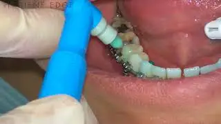 Occlusal Brush For Ortho Demonstration